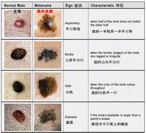 屁股的痣|臀部的痣需要预防性切除吗？